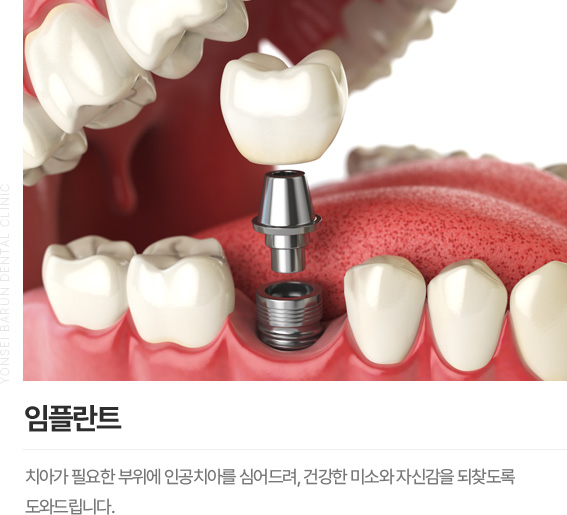 임플란트
